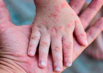 Segundo caso de viruela símica en Rosario: ¿Qué debes saber?