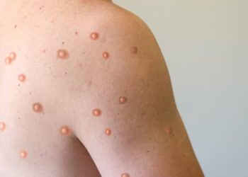 Primeros casos de Viruela del Mono en Argentina , uno en Santa Fe.