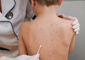 Suba de casos de sarampión y la importancia de la vacunación