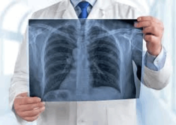 Día Mundial del Cáncer de Pulmón: alertan sobre el aumento de casos