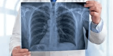 Día Mundial del Cáncer de Pulmón: alertan sobre el aumento de casos