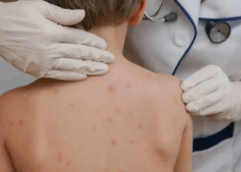 El gobierno de Santa Fe activó el protocolo por sarampión tras el paso de una familia de Uruguay con casos confirmados