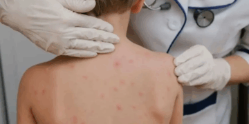 El gobierno de Santa Fe activó el protocolo por sarampión tras el paso de una familia de Uruguay con casos confirmados