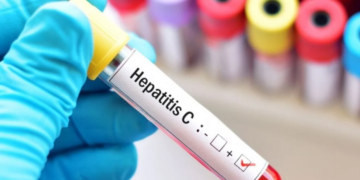 8 de cada 10 personas con hepatitis C aún no se trataron para curarse